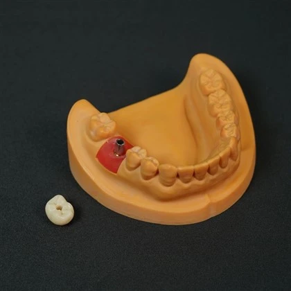 Cấy ghép toàn bộ vương miện zirconia